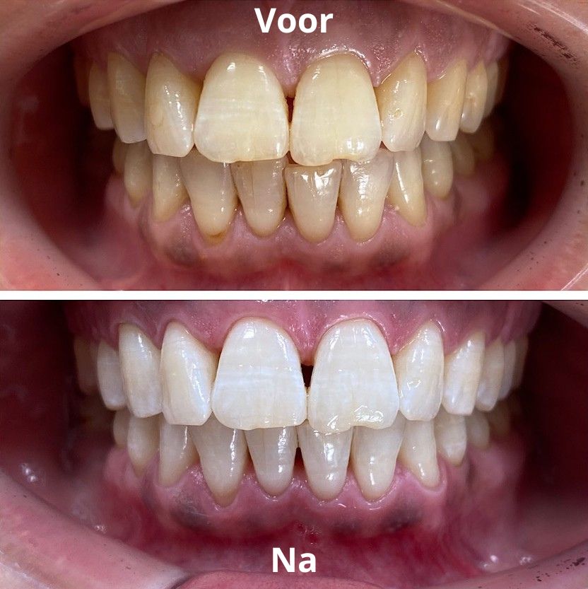 Tanden Bleken Tandarts Genk: Stralende Wittere Tanden - Tanden Bleken - Wittere Tanden - SoCleanClinic.be thumbnail
